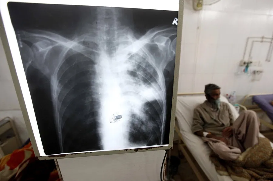 Aumento de los casos de tuberculosis Cuáles son las causas del repunte