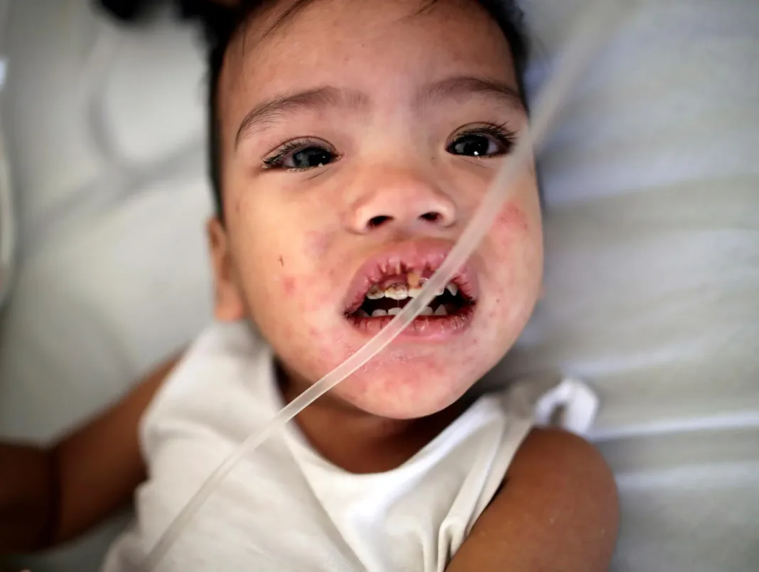 Muere un segundo niño por sarampión en Texas Cuántos infectados hay