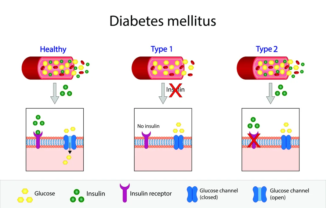 Diabetes mellitus: la silenciosa enfermedad que afecta a millones