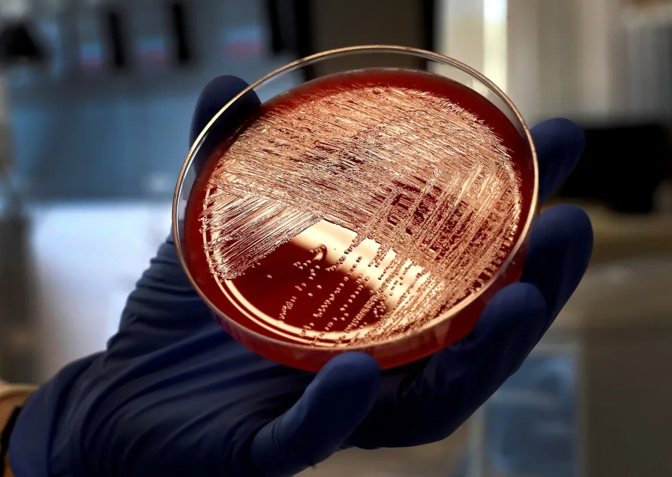 Hay 10 hospitalizados por un brote de listeria: ¿Cómo prevenirla?